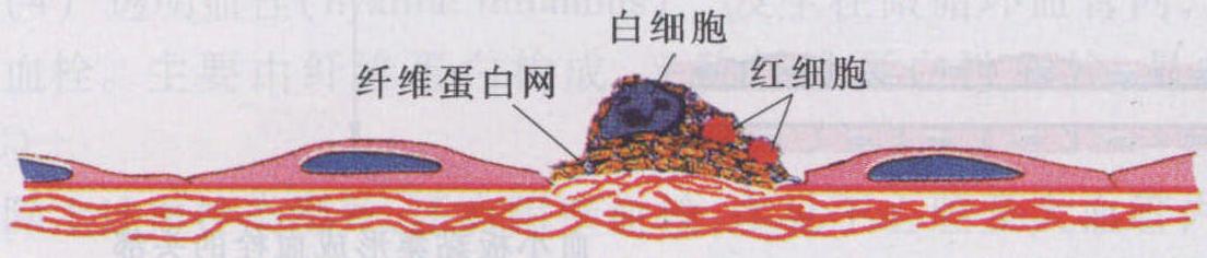 血栓形成的條件及機(jī)制